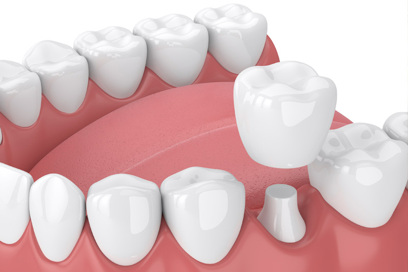 Dental Crowns in Media