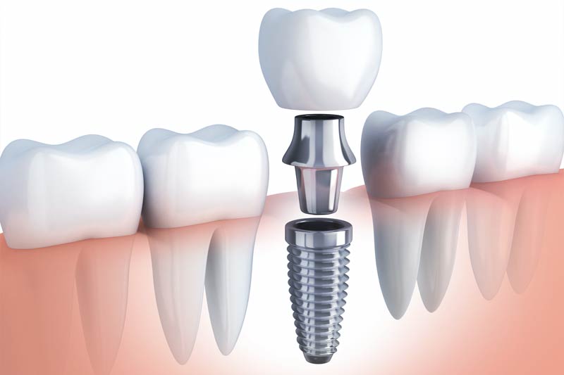 Implants Dentist in Media