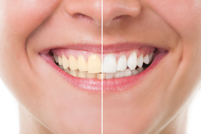 Teeth Whitening in Media