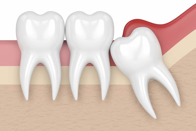 Wisdom Tooth Removal in Media