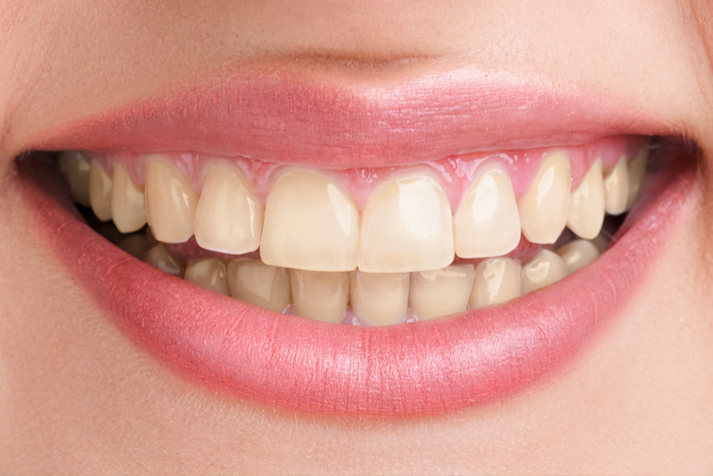 Up-close image of a smiling woman before teeth whitening
