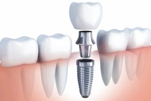 Dental implant example pic