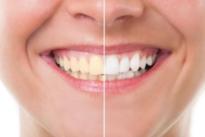 Before and after clean teath